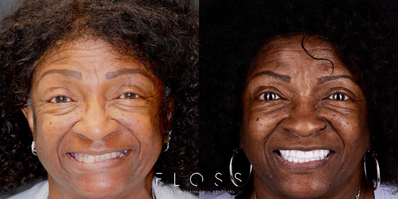 Before and after transformation of dental implant recipient BA at FLOSS Dental with Dr. Mike Tran